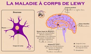 Qu'est-ce que la maladie à corps de Lewy qui a emporté Nathalie Baye ?